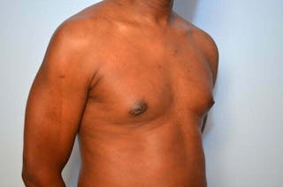 Male Breast Reduction Before & After Gallery - Patient 385736 - Image 4