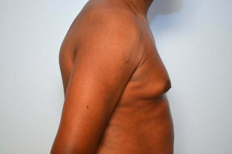 Male Procedures by Dr. Hess Before & After Gallery - Patient 385736 - Image 5