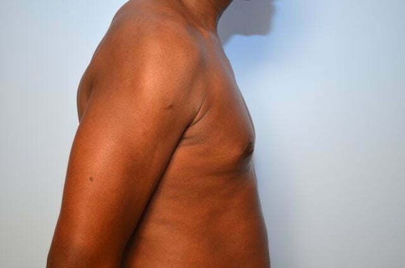 Male Procedures by Dr. Hess Before & After Gallery - Patient 385736 - Image 6