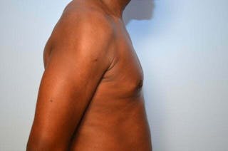 Male Breast Reduction Before & After Gallery - Patient 385736 - Image 6