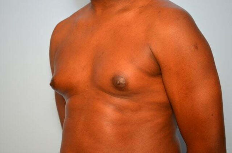 Male Procedures by Dr. Hess Before & After Gallery - Patient 385736 - Image 7