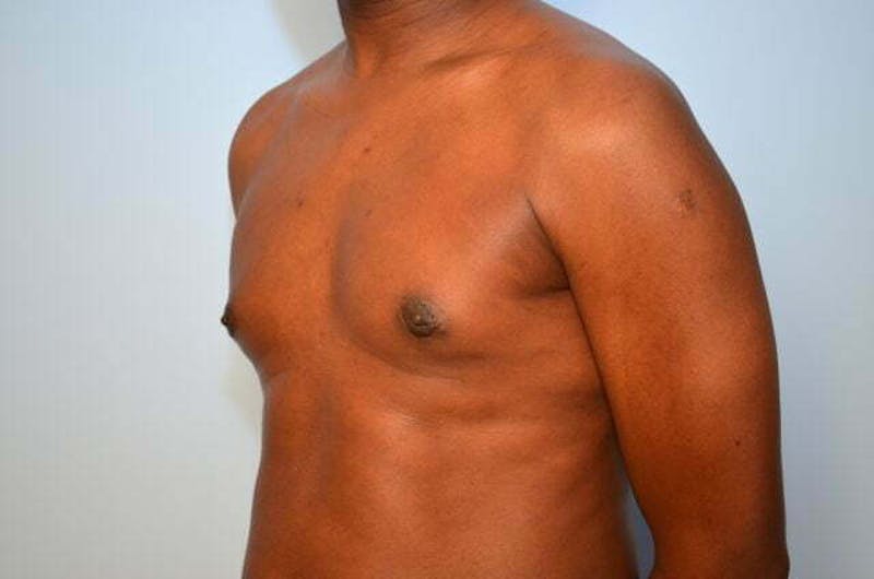 Male Procedures by Dr. Hess Before & After Gallery - Patient 385736 - Image 8