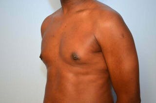 Male Breast Reduction Before & After Gallery - Patient 385736 - Image 8