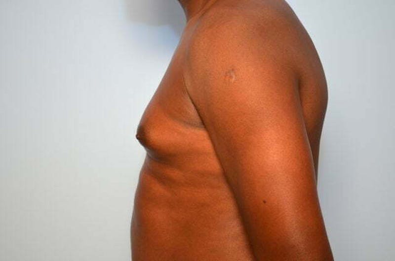 Male Procedures by Dr. Hess Before & After Gallery - Patient 385736 - Image 9