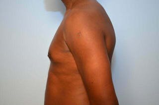 Male Breast Reduction Before & After Gallery - Patient 385736 - Image 10