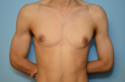 Male Procedures by Dr. Hess Before & After Gallery - Patient 220605 - Image 1