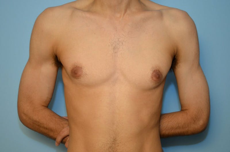 Male Procedures by Dr. Hess Before & After Gallery - Patient 220605 - Image 1
