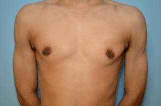 Male Breast Reduction Before & After Gallery - Patient 220605 - Image 2