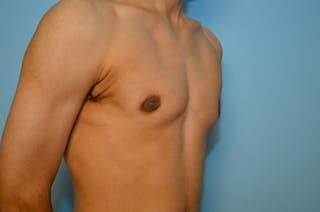 Male Breast Reduction Before & After Gallery - Patient 220605 - Image 4