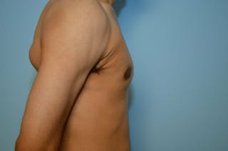 Male Breast Reduction Before & After Gallery - Patient 220605 - Image 6
