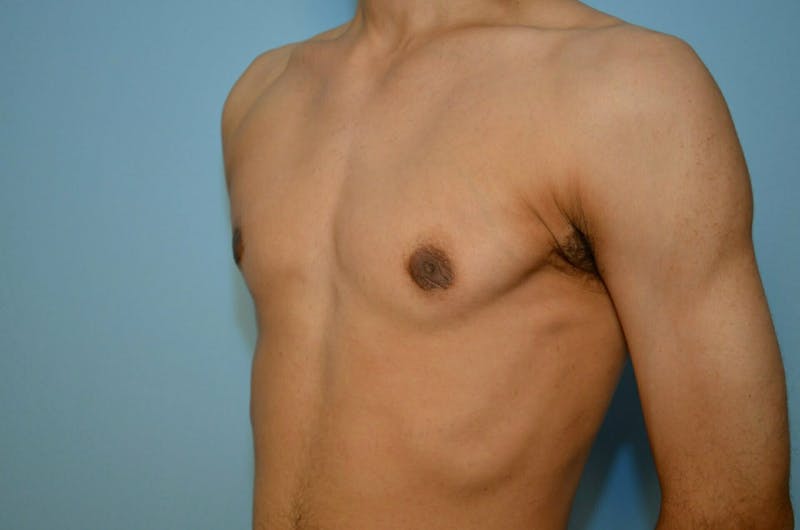 Male Procedures by Dr. Hess Before & After Gallery - Patient 220605 - Image 8