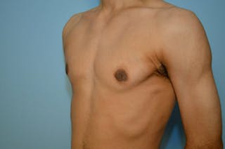 Male Breast Reduction Before & After Gallery - Patient 220605 - Image 8