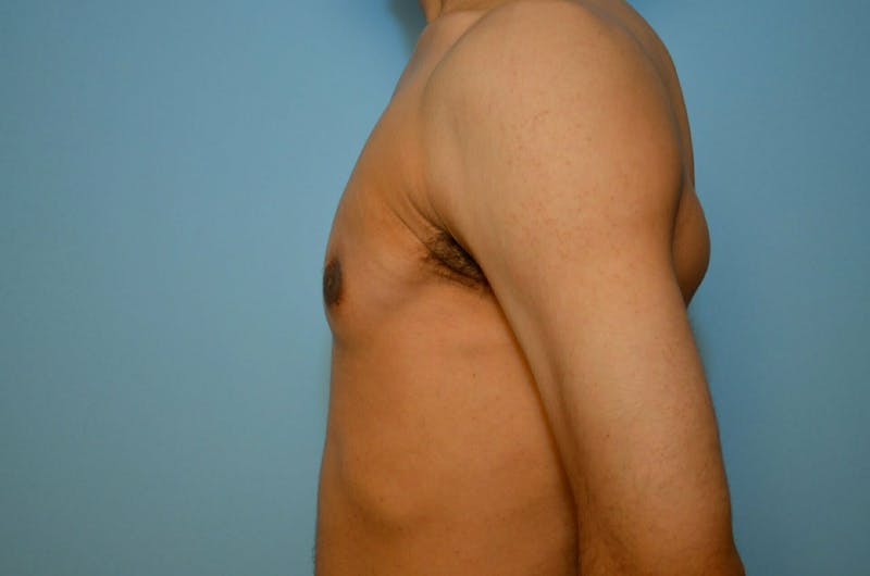 Male Procedures by Dr. Hess Before & After Gallery - Patient 220605 - Image 10