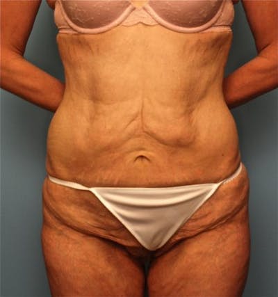 Thigh Lift Before & After Gallery - Patient 339782 - Image 1