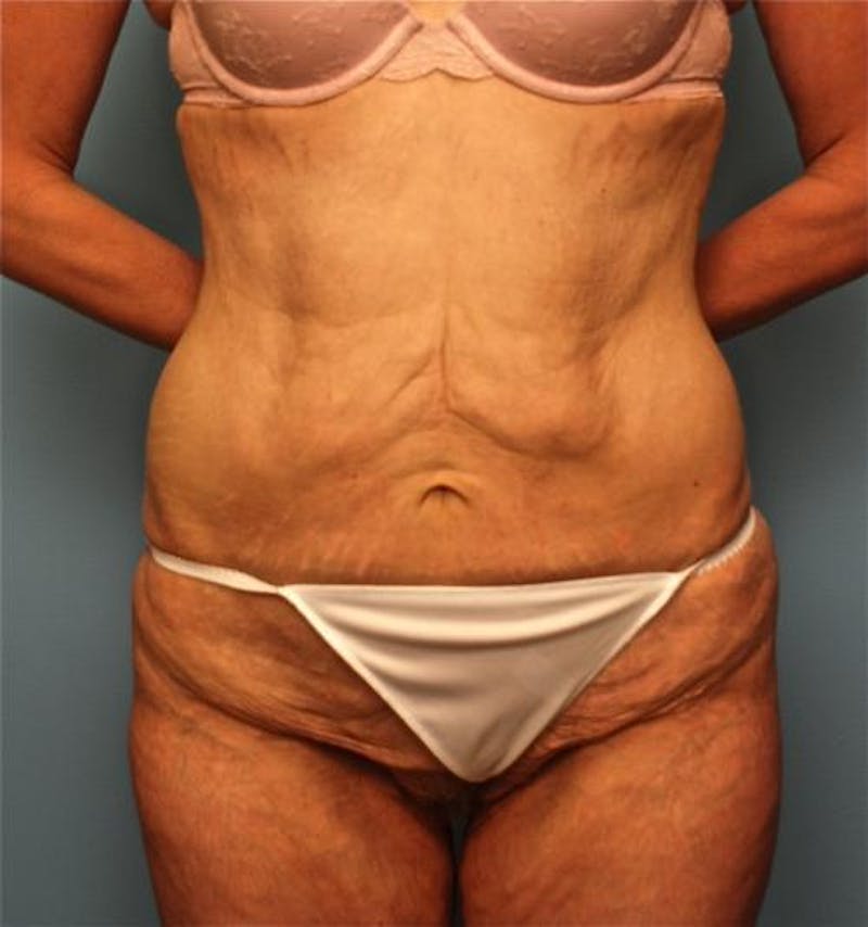 Thigh Lift Before & After Gallery - Patient 167922 - Image 1