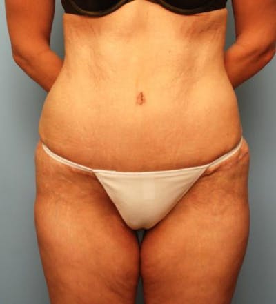 Thigh Lift Before & After Gallery - Patient 339782 - Image 2