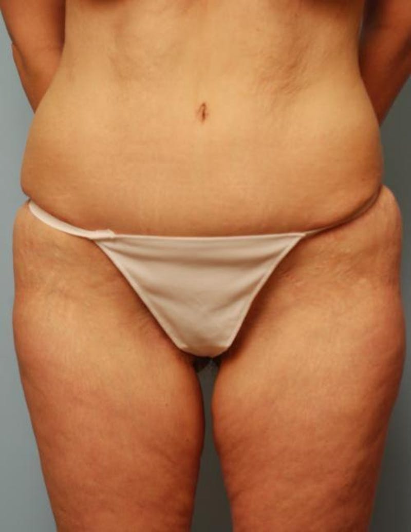 Tummy Tuck Before & After Gallery - Patient 325168 - Image 2