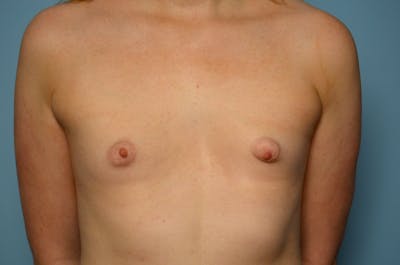 Tubular Breast Deformity Before & After Gallery - Patient 158290 - Image 1
