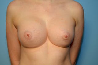 Tubular Breast Deformity Before & After Gallery - Patient 403569 - Image 2