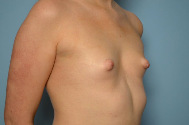 Tubular Breast Deformity Before & After Gallery - Patient 403569 - Image 3