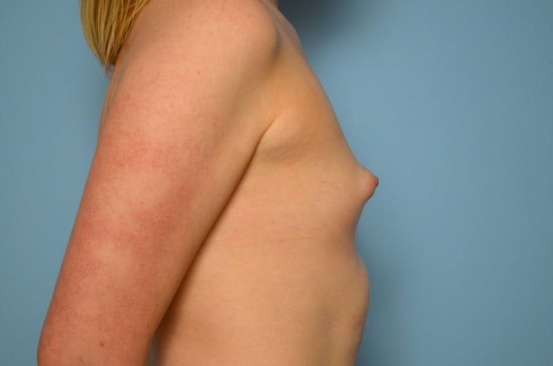 Tubular Breast Deformity Before & After Gallery - Patient 403569 - Image 5