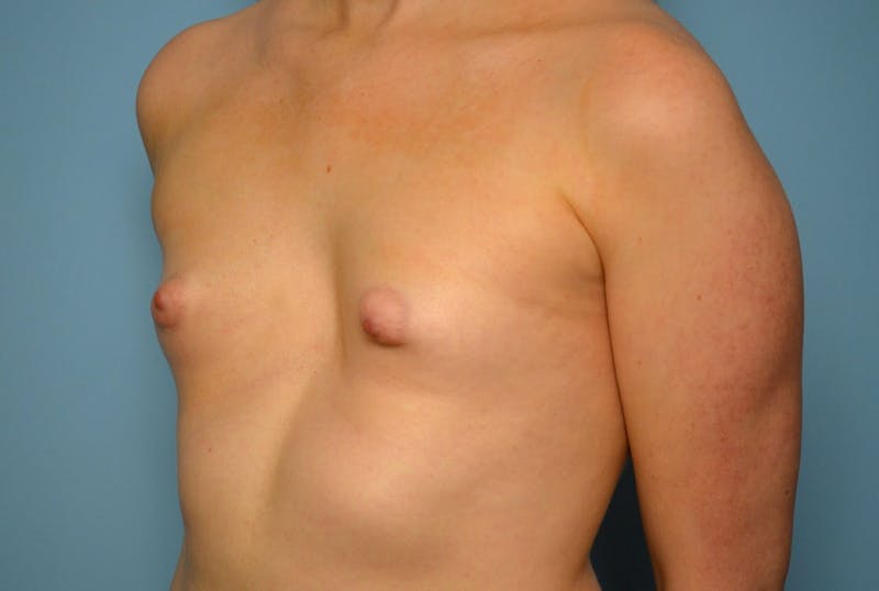 Tubular Breast Deformity Before & After Gallery - Patient 403569 - Image 7