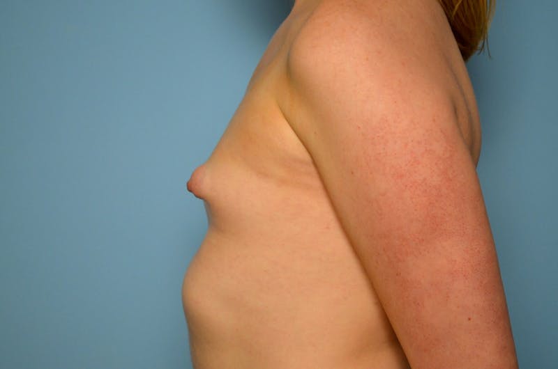 Tubular Breast Deformity Before & After Gallery - Patient 403569 - Image 9