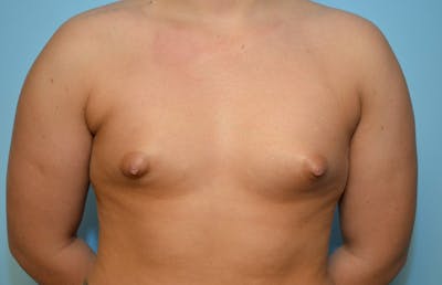 Tubular Breast Deformity Before & After Gallery - Patient 961570 - Image 1