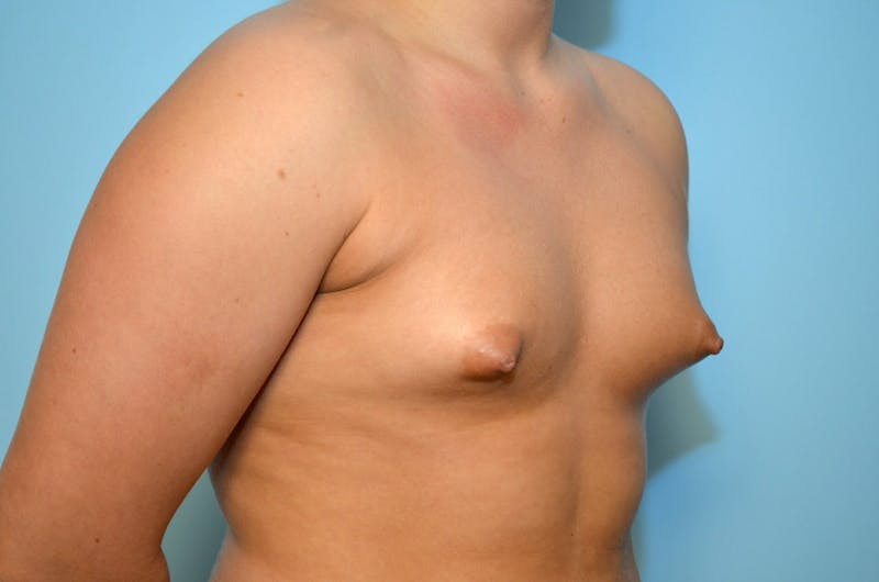 Tubular Breast Deformity Before & After Gallery - Patient 392289 - Image 3