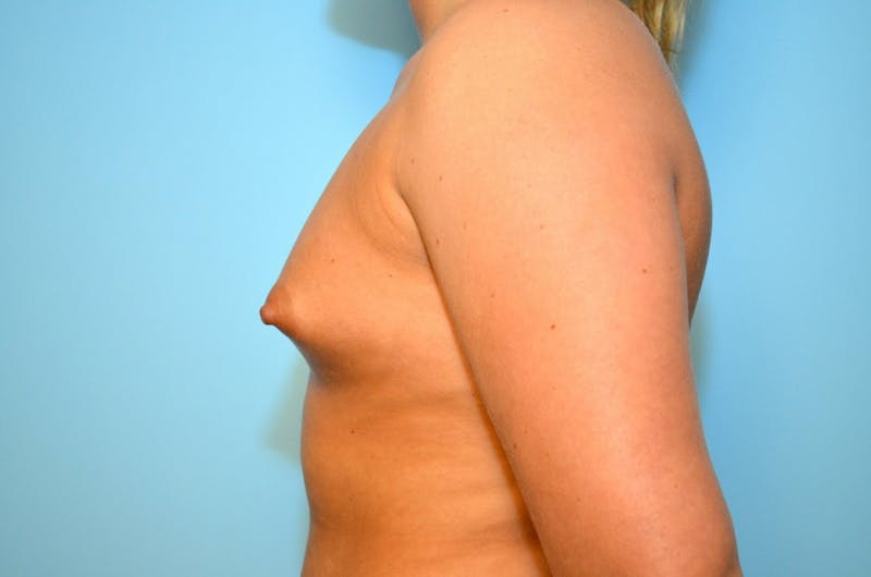 Tubular Breast Deformity Before & After Gallery - Patient 392289 - Image 9