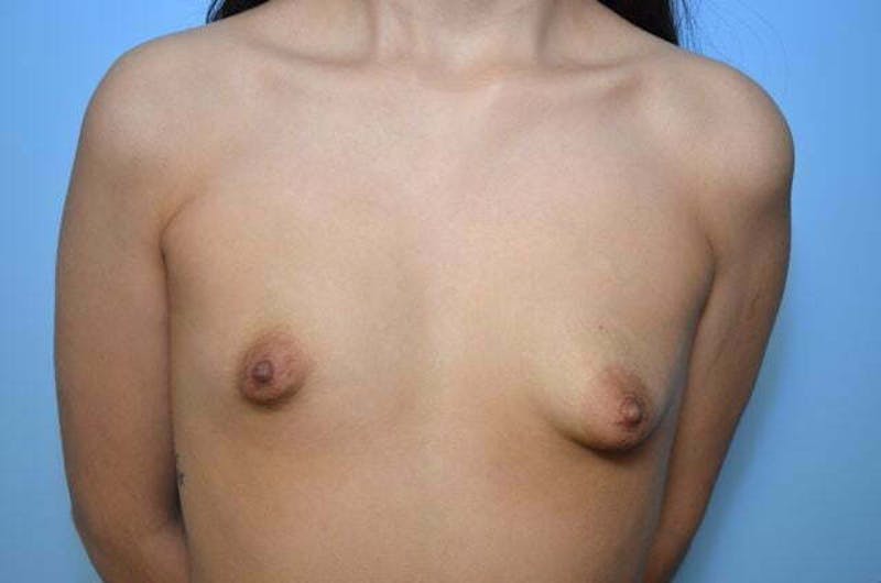 Tubular Breast Deformity Before & After Gallery - Patient 795906 - Image 1