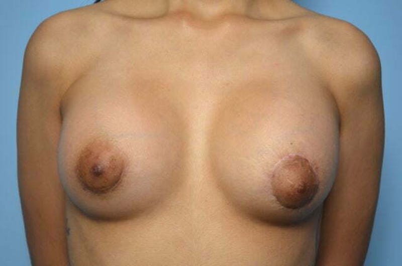 Tubular Breast Deformity Before & After Gallery - Patient 795906 - Image 2
