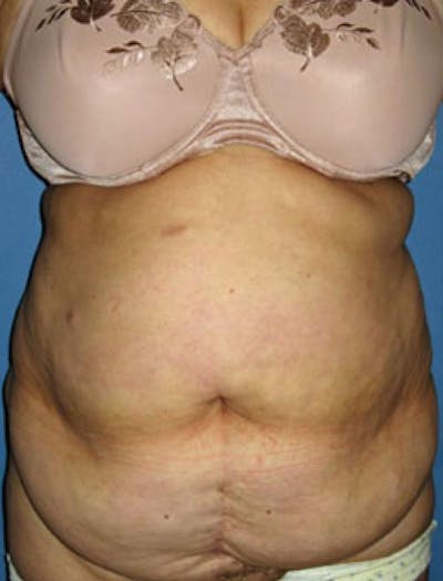 Tummy Tuck Before & After Gallery - Patient 162078 - Image 1