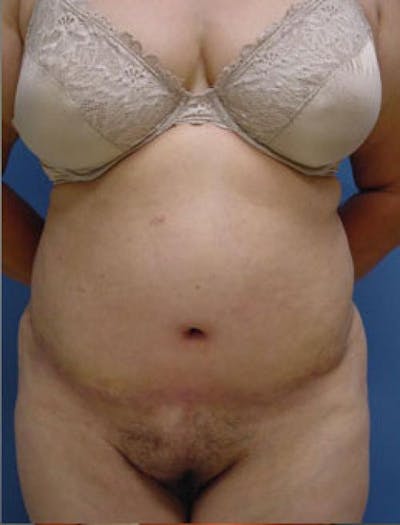Tummy Tuck Before & After Gallery - Patient 162078 - Image 2