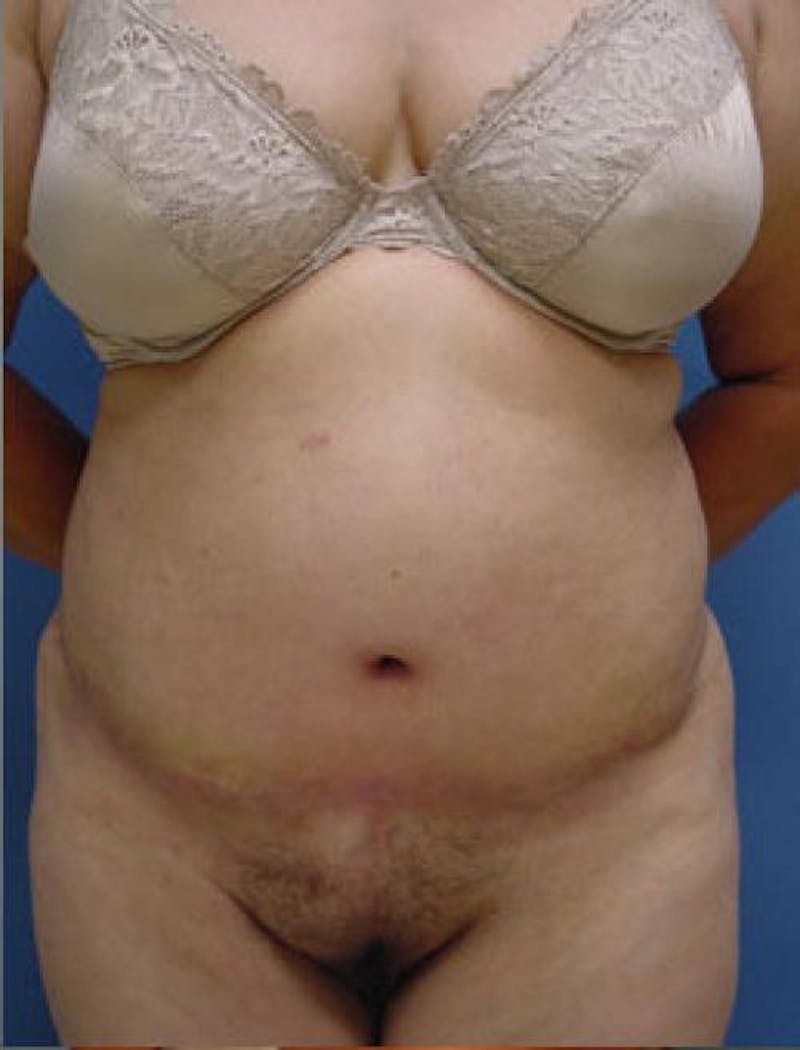 Tummy Tuck Before & After Gallery - Patient 185065 - Image 2