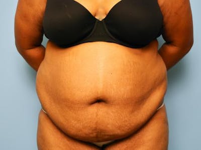 Tummy Tuck Before & After Gallery - Patient 283681 - Image 1
