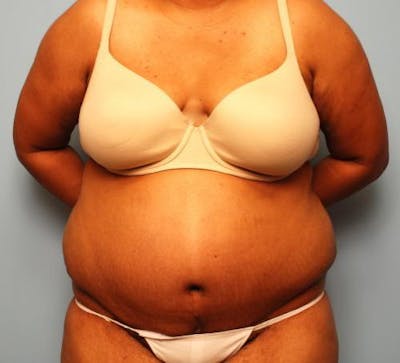 Tummy Tuck Before & After Gallery - Patient 283681 - Image 2