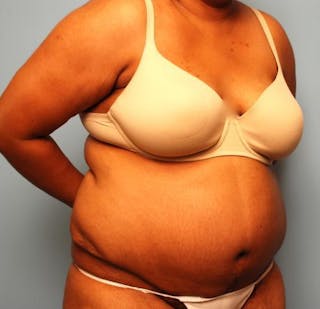 Tummy Tuck Before & After Gallery - Patient 105514 - Image 4