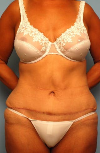 Tummy Tuck Before & After Gallery - Patient 374694 - Image 2
