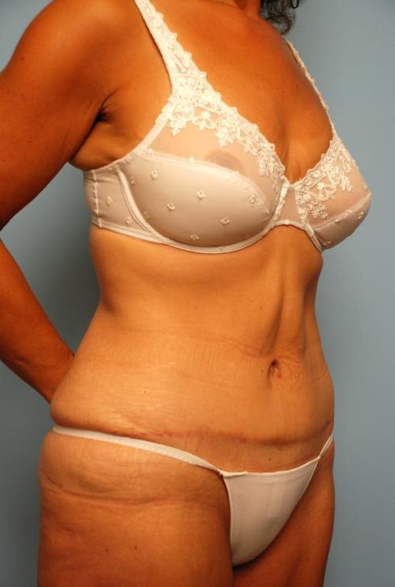 Tummy Tuck Before & After Gallery - Patient 374694 - Image 4