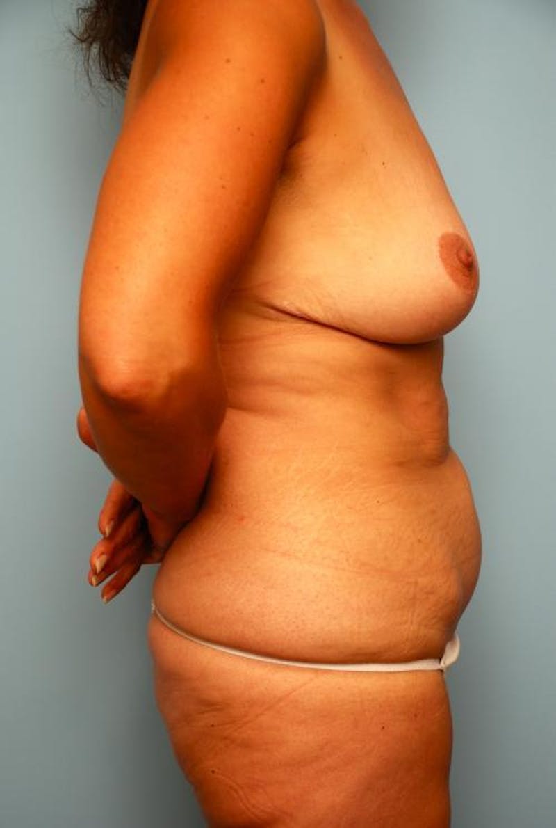 Tummy Tuck Before & After Gallery - Patient 374694 - Image 5