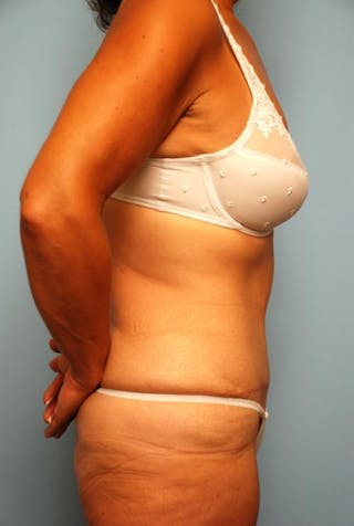 Tummy Tuck Before & After Gallery - Patient 374694 - Image 6