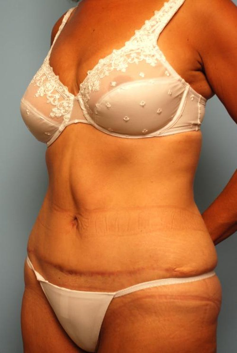 Tummy Tuck Before & After Gallery - Patient 374694 - Image 8