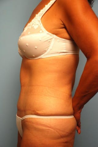 Tummy Tuck Before & After Gallery - Patient 374694 - Image 10