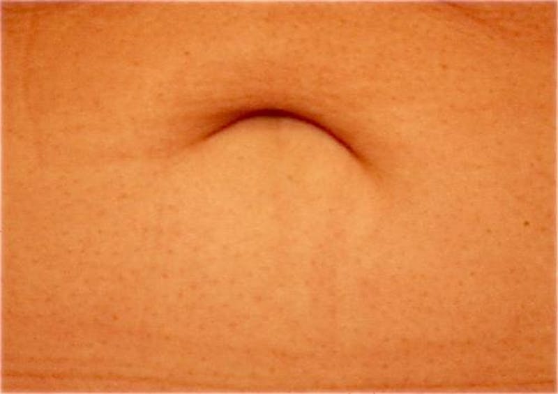Tummy Tuck Before & After Gallery - Patient 374694 - Image 11