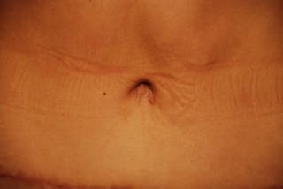 Tummy Tuck Before & After Gallery - Patient 374694 - Image 12