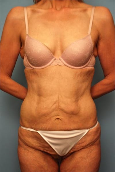 Tummy Tuck Before & After Gallery - Patient 270479 - Image 1