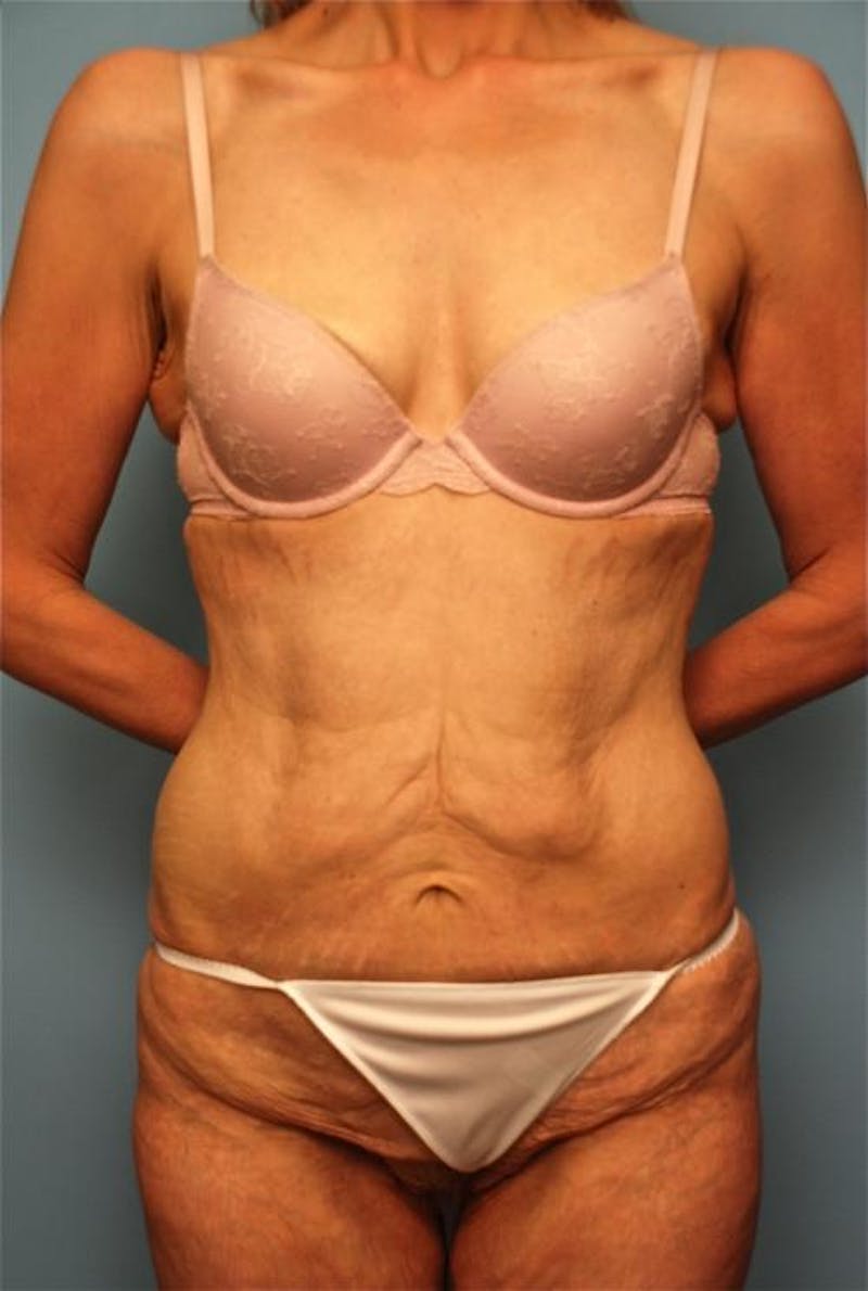 Tummy Tuck Before & After Gallery - Patient 277555 - Image 1