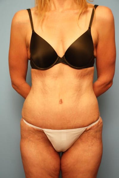 Tummy Tuck Before & After Gallery - Patient 270479 - Image 2