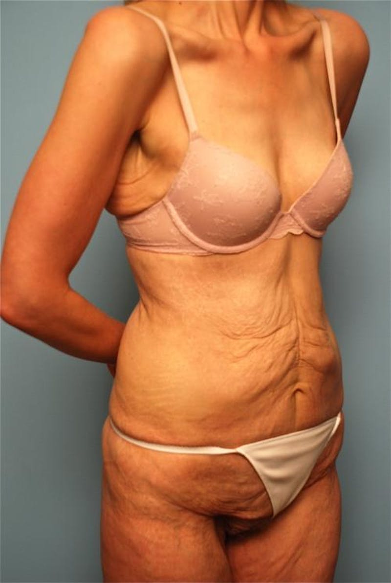 Tummy Tuck Before & After Gallery - Patient 277555 - Image 3